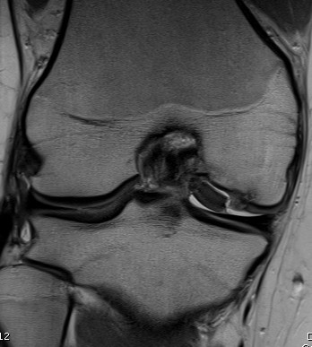 MRI Knee Displaced OCD